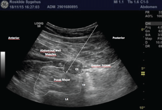 Ultrasound-guided Transmuscular Quadratus Lumborum (TQL ...