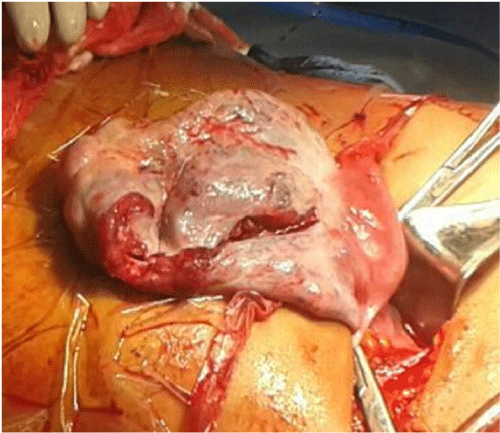Figure 1: Photo taken at laparotomy. The left ovarian cyst after clamping the
pedicle, showing the site of capsule rupture.