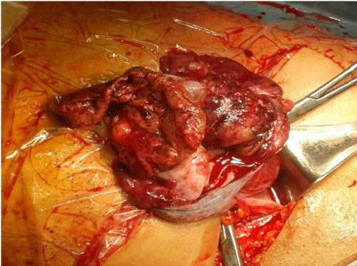 Figure 2: Showing the inside of the ruptured left-sided ovarian cyst after
clamping the ovarian pedicle.