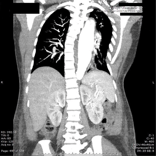 Figure 3: Computed tomography angiogram chest with contrast in
postpartum. New descending thoracic aortic dissection and interval
enlargement of the fusiform descending thoracic aneurysm from one day
prior, now maximum 45mm.
