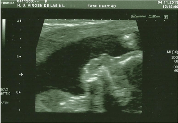 Figure 1: In the 20th week, the ultrasound evaluation show a hypoplastic
nasal bone, measuring 1,9mm (abdominal probe, Toshiba Xsario X6).