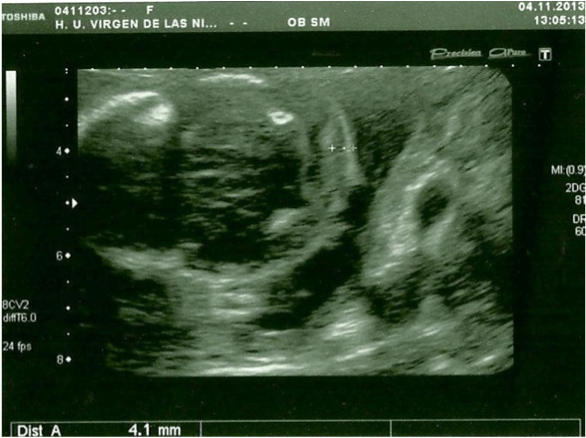 Figure 2: Axial prenatal ultrasonogram of a fetal head reveal normal nuchal
translucency (abdominal probe, Toshiba Xsario X6).