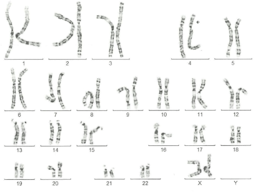 Figure 4: a-CGH profile of chromosome 4 showing a terminal deletion. To
the right, the whole chromosomes 4 view. To the left, the enlarged view of
the rearrangement as provided by Labco. The overall size of the deletion
was about 9.5Mb.