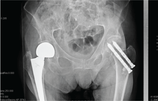 displaced subcapital femoral neck fracture