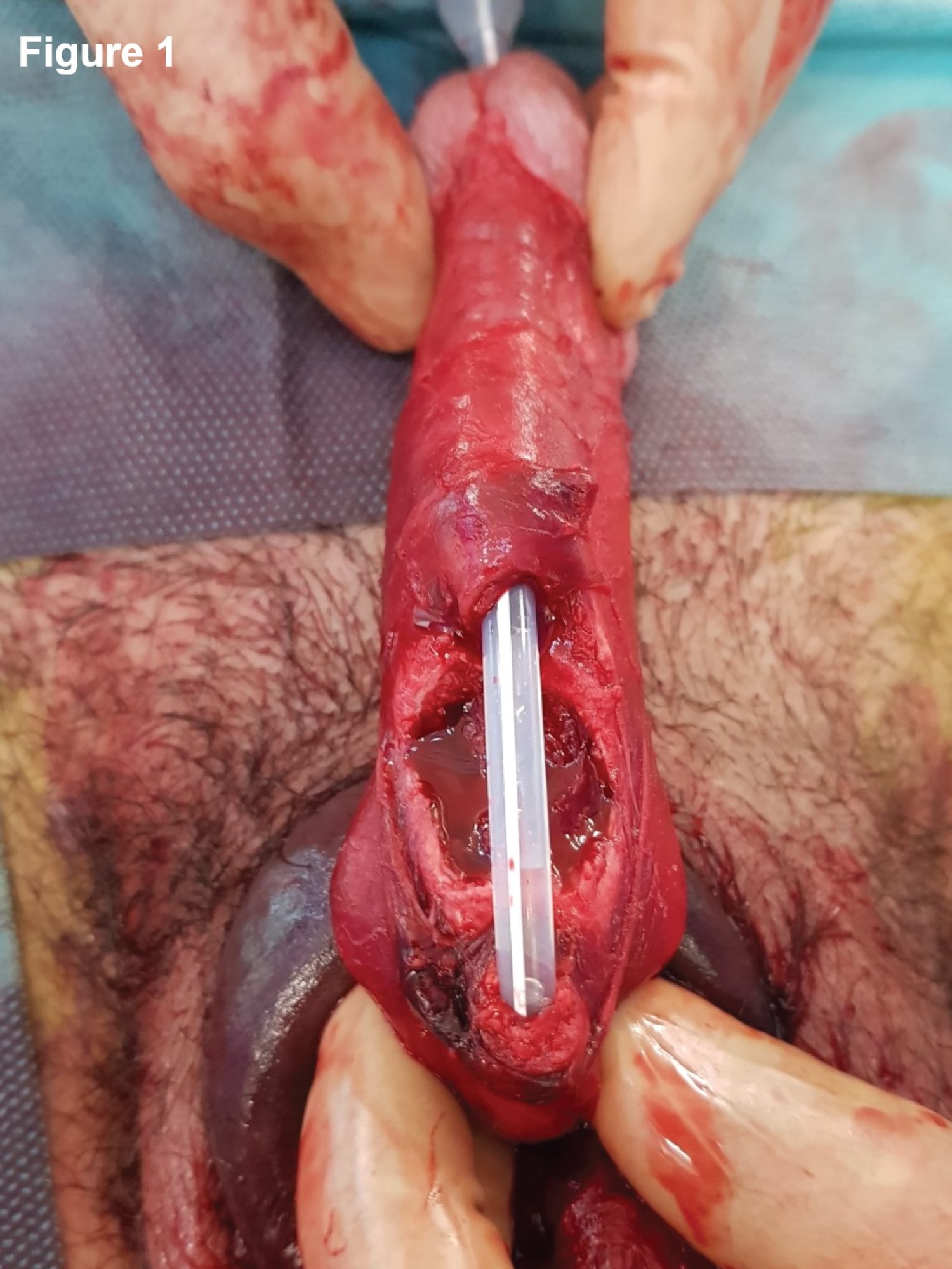 penile fracture symptoms photos