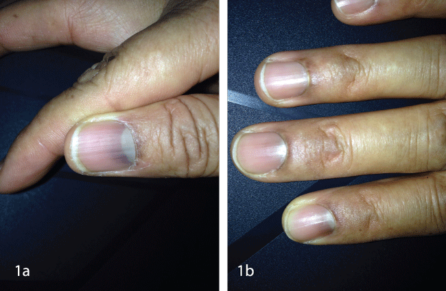 Blue Fingernails during Treatment with Cyclophosphamide for Minimal Change  Disease: A Very Rare Side Effect