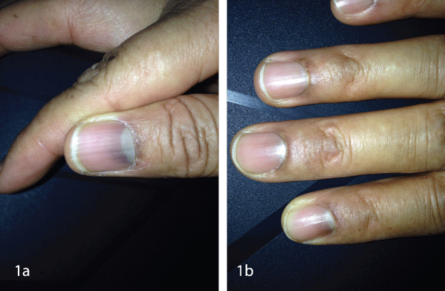 Aggregate 124+ blue nails disorder super hot - ceg.edu.vn