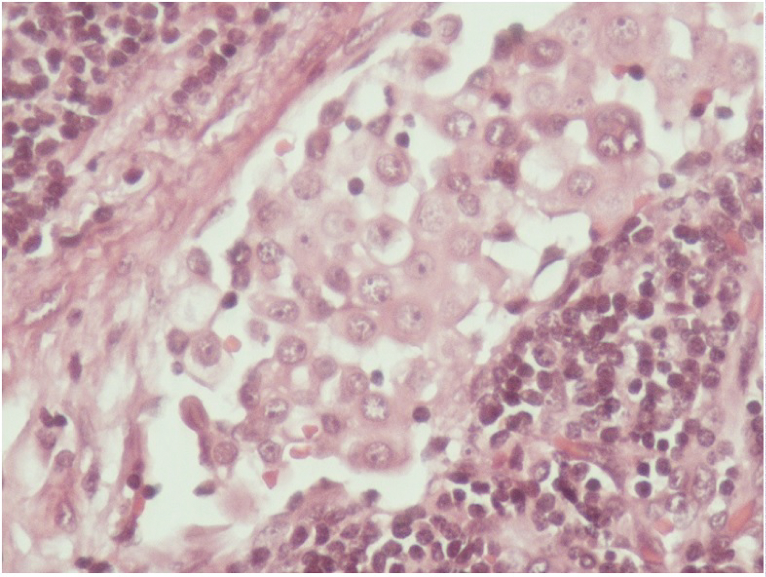 Mesothelial Cells in Lymph Nodes Associated with Massive Pericardial