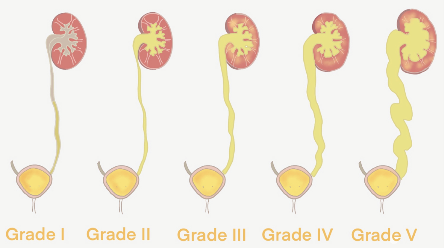 Bilateral Hydronephrosis As A Consequence Of Vesicoureteral Reflux In A 6 Year Old Male Patient