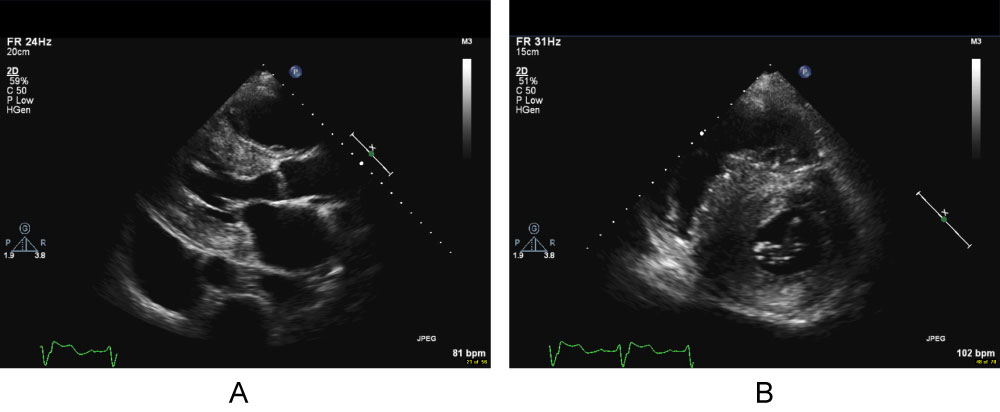 A case of cardiac amyloidosis with left ventricular outflow obstruction  with significant response to therapy