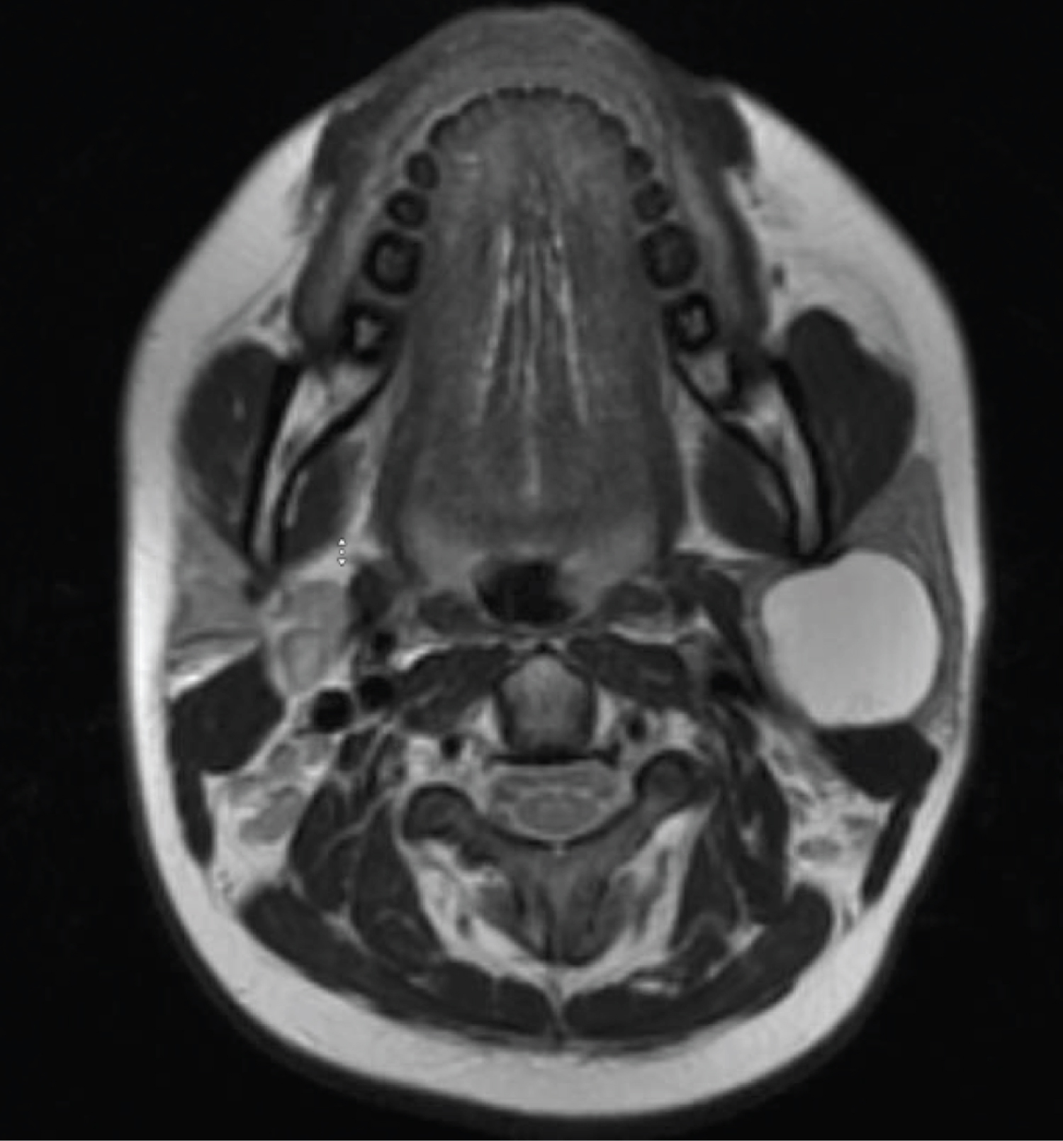 branchial cleft cyst ultrasound