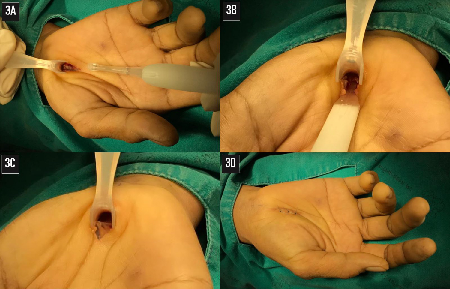 Carpal Tunnel decompression: Extended approach Surgical Technique