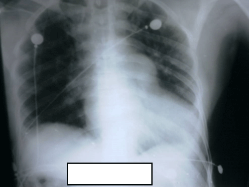 Figure 2: Chest radiograph showing cardiomegaly and prominence of
pulmonary arteries.