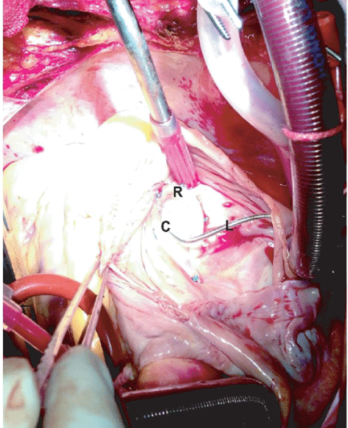 Figure 1: The picture of tricuspid valve after the plasty. (L: the lead of PPM,
R: 28 # Edwards MC3 ring, C: the posterior septal commissure).