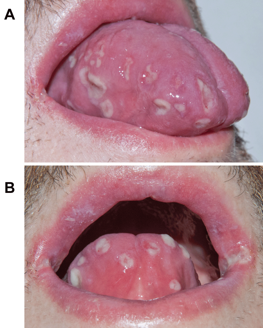 Hypersensitivity Reaction with Extensive Oral Ulcerations | ClinMed International Library | Journal of Dermatology Research and