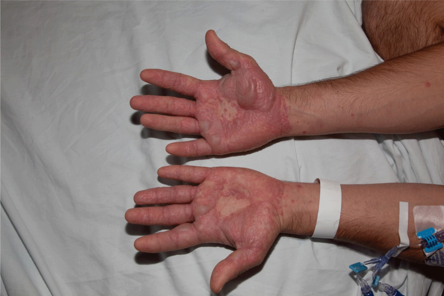 What Is Stevens Johnson Syndrome Lifestyle