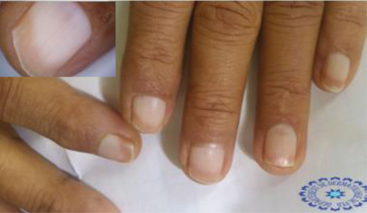 An Atlas of Nail Disorders, Part 14 | Consultant360