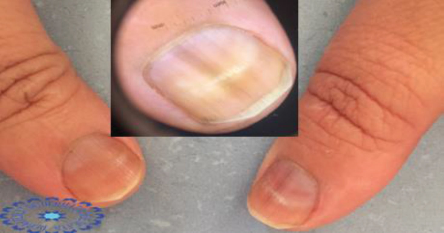 Nail the Diagnosis of Half-and-Half-Nails | VisualDx