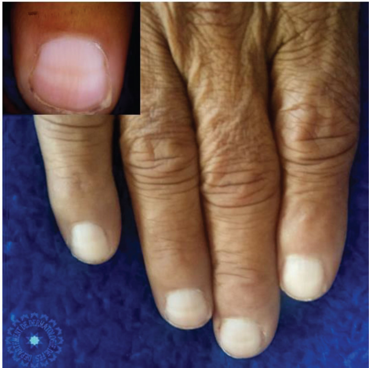 Nail signs of systemic diseases 指甲症狀與全身性疾病@ 快樂小藥師Im pharmacist nichts  glücklich :: 痞客邦::