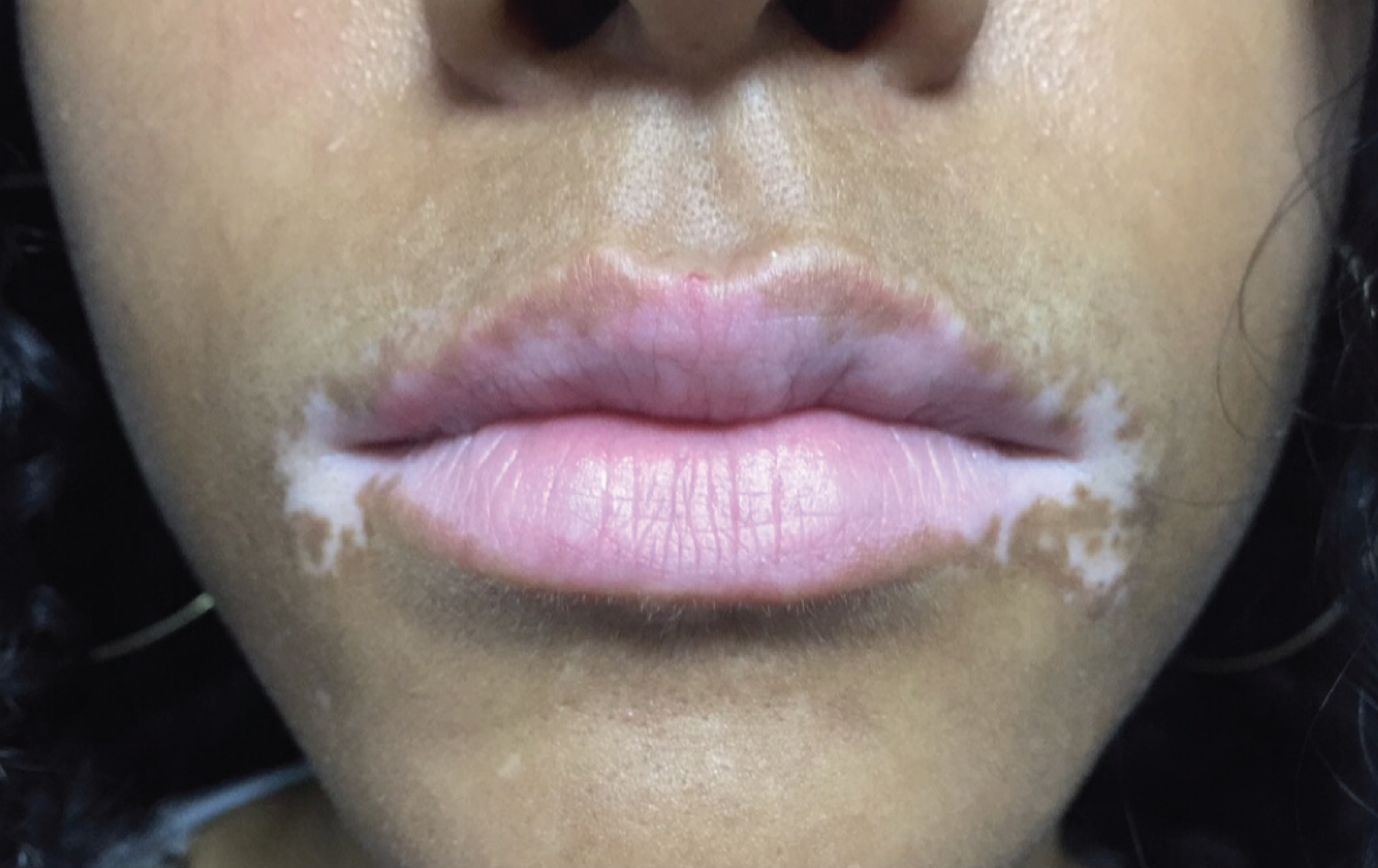 Perioral Köebner Phenomenon Following Lip Licking Dermatitis in a Patient  with Acrofacial Vitiligo