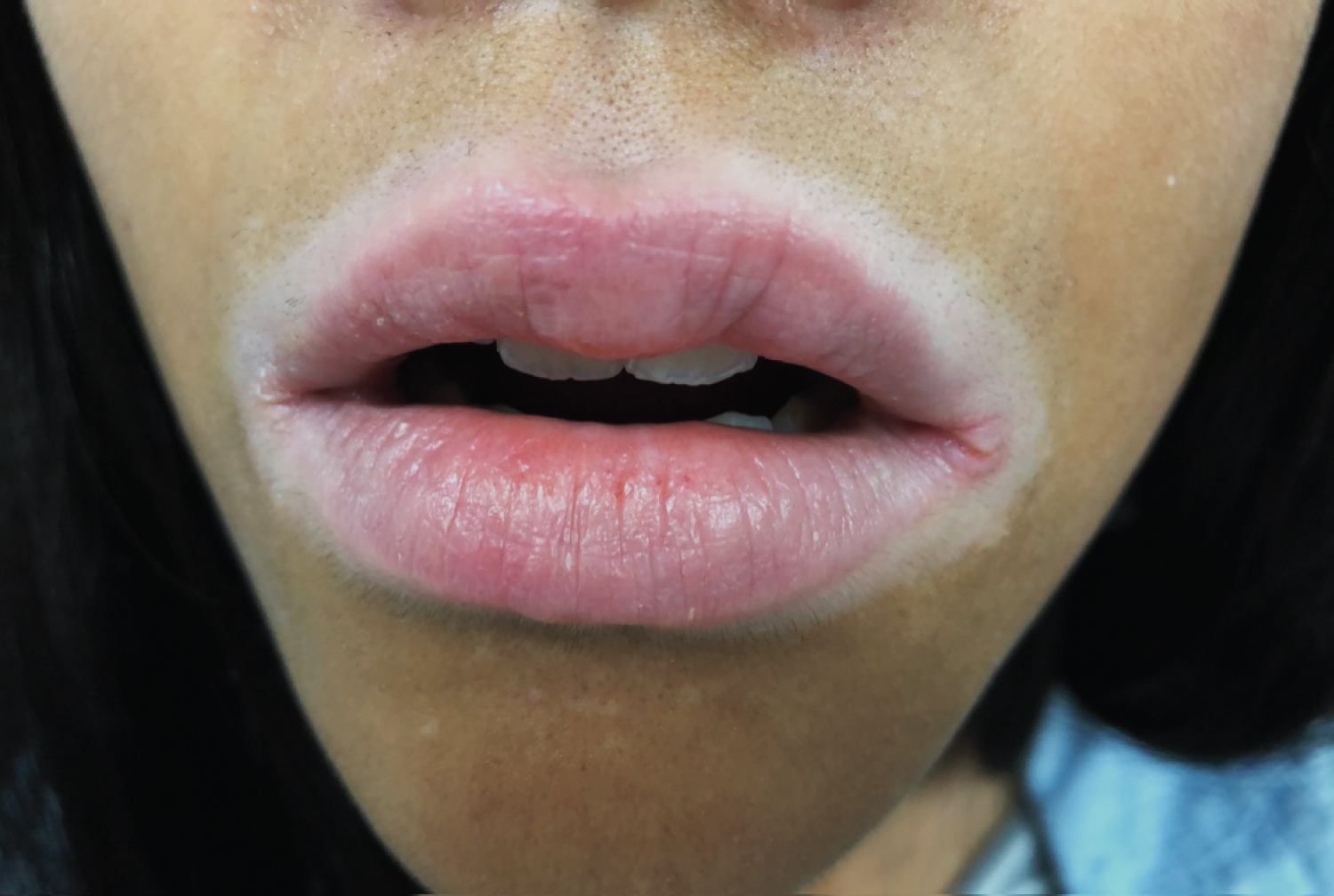 Perioral Köebner Phenomenon Following Lip Licking Dermatitis in a Patient  with Acrofacial Vitiligo