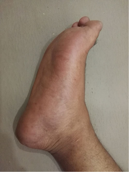 swollen arch of foot