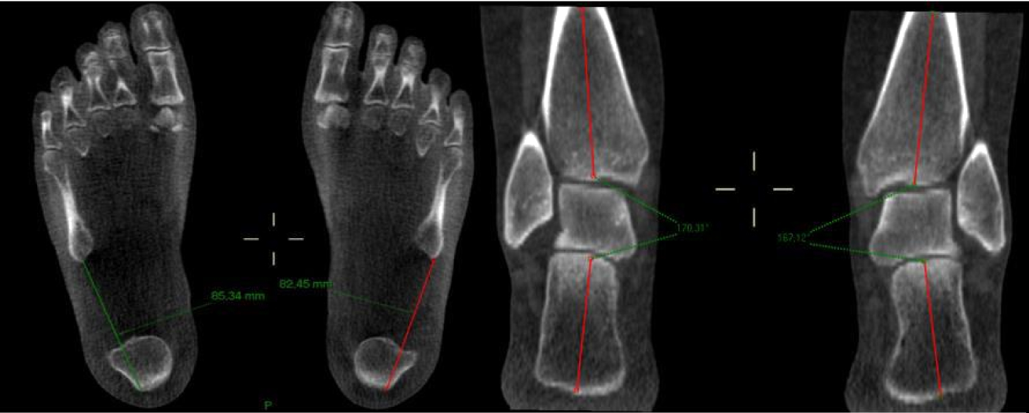 Styloid Process Foot