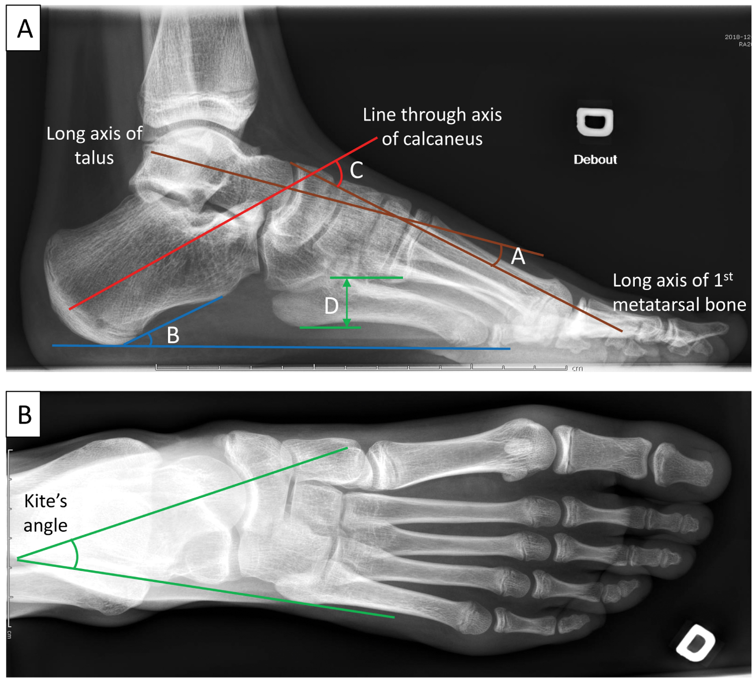 Share 128+ heel weight bearing only super hot - esthdonghoadian