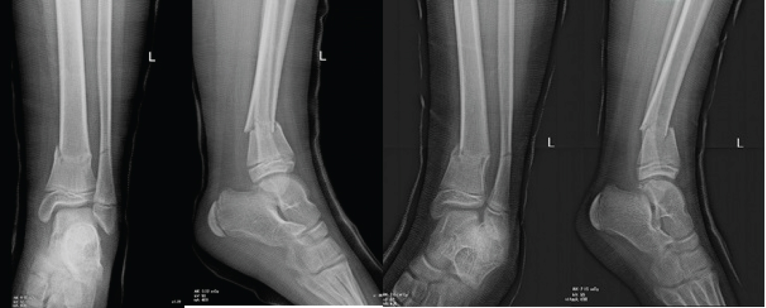 distal tibia fracture