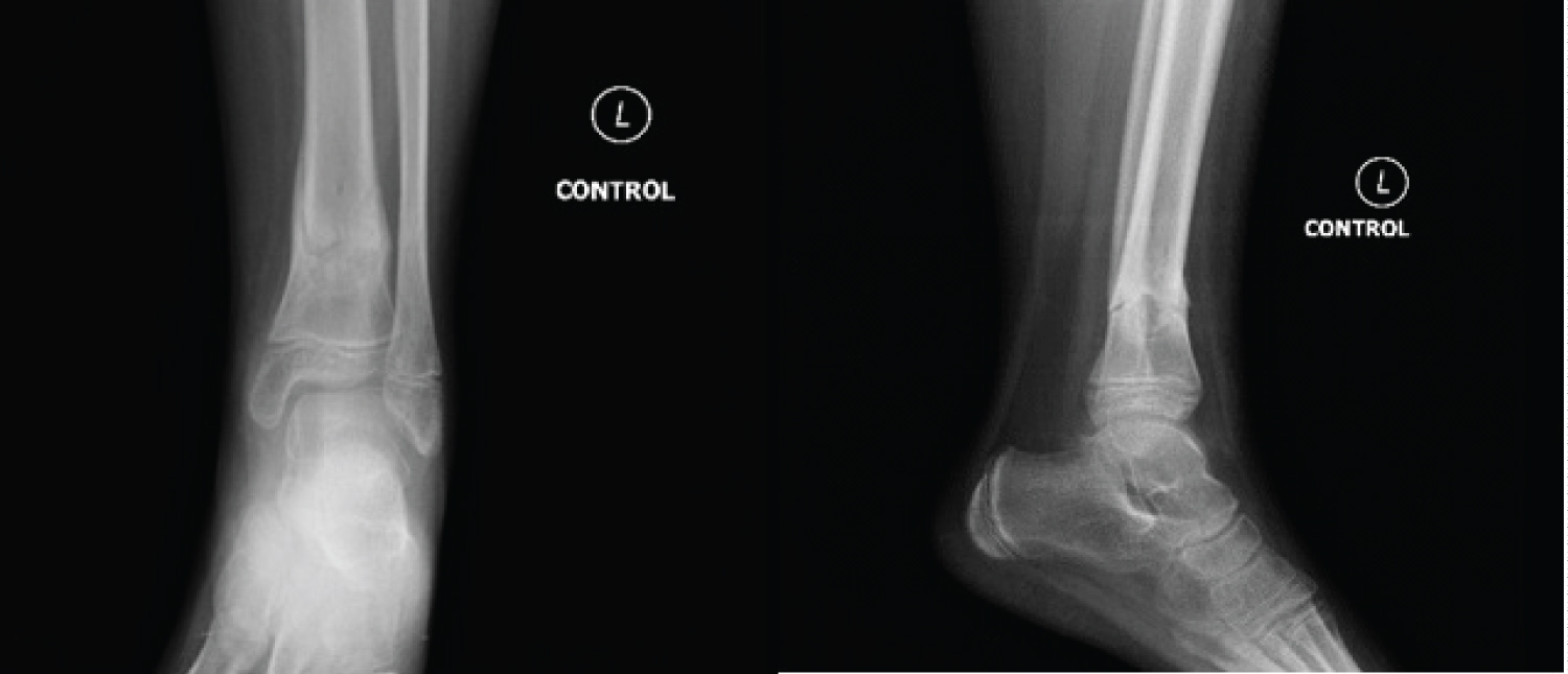 Distal Tibial Metaphyseal Fractures In Children Treatment By Intrafocal