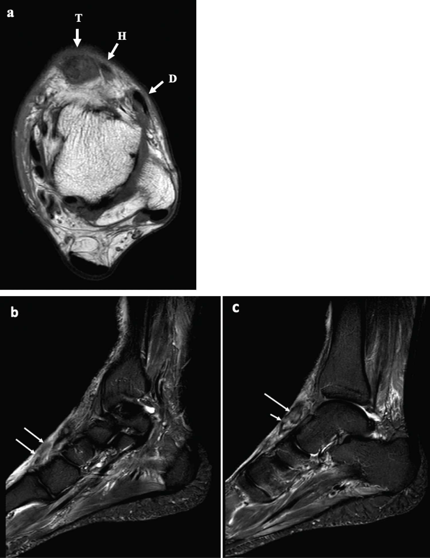 Expedited Diagnosis And Surgical Repair Of Isolated Acute Anterior
