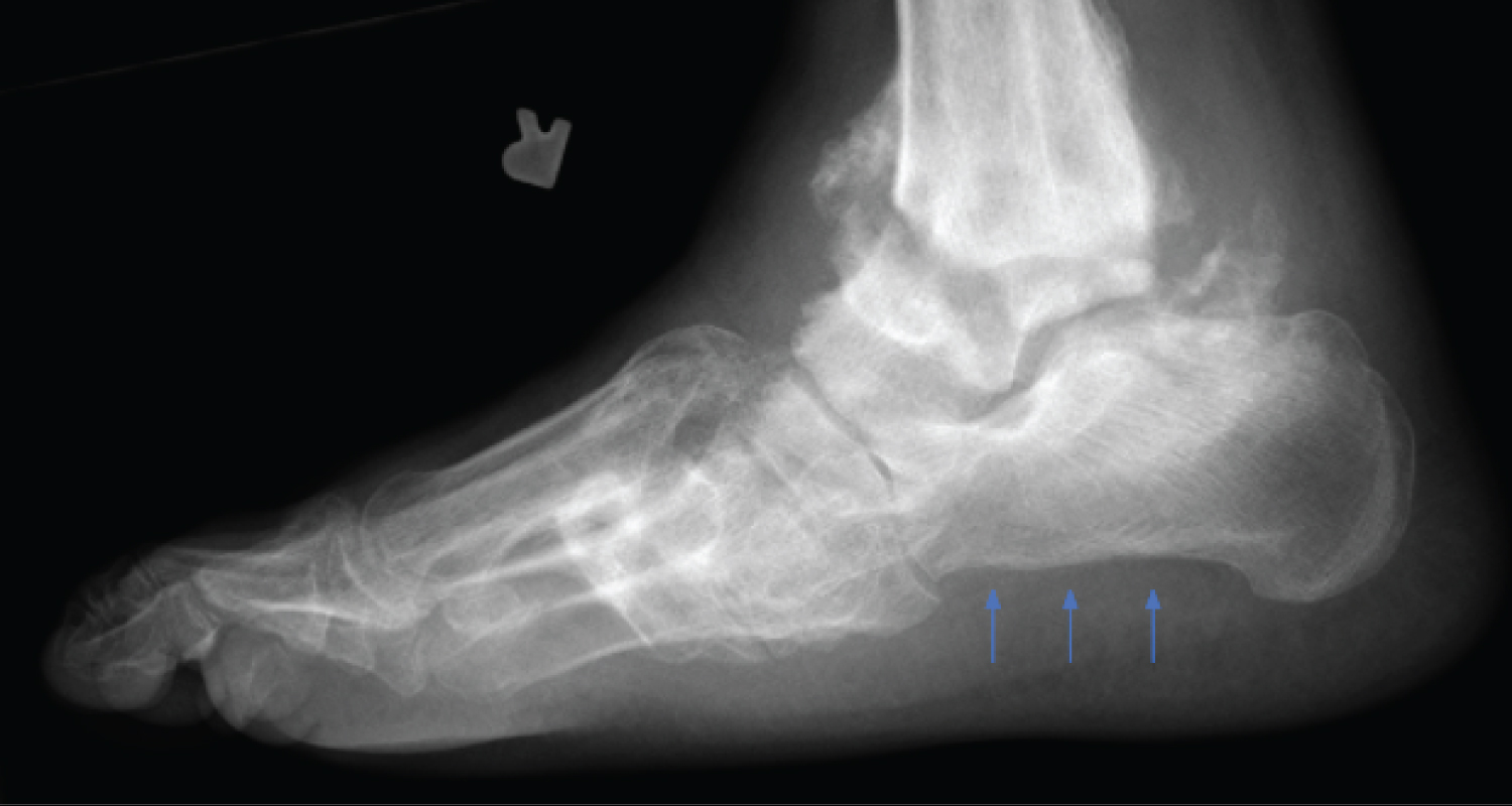The Impact of the Plantar Calcaneal Cortex on Ankle Charcot Reconstruction