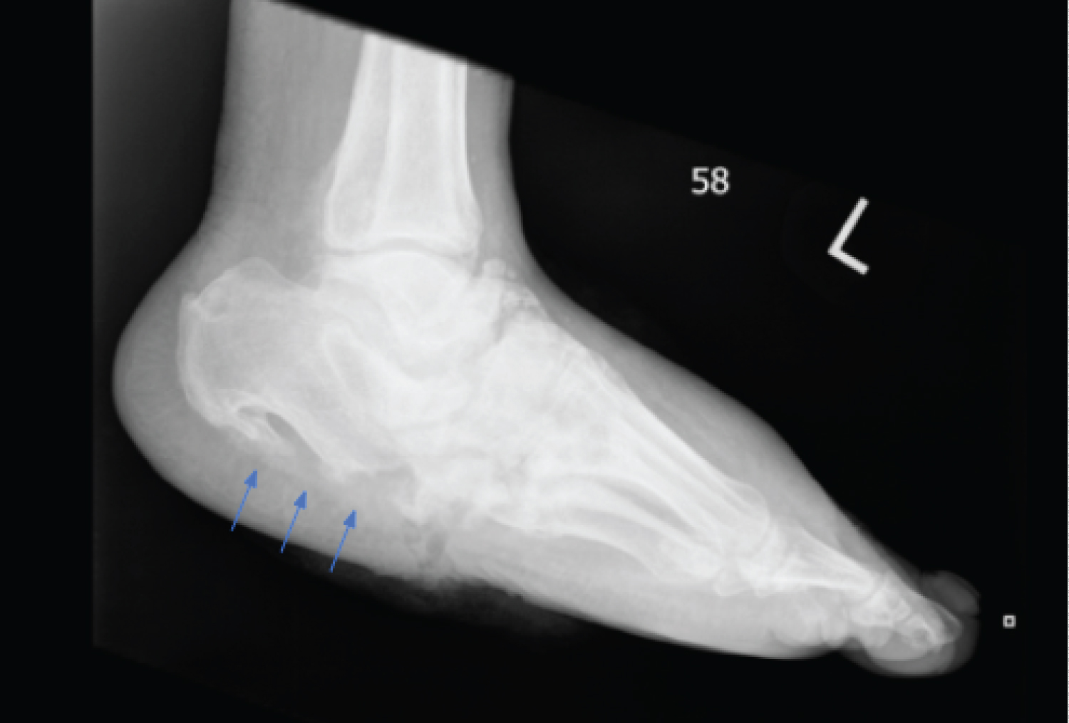 The Impact of the Plantar Calcaneal Cortex on Ankle Charcot Reconstruction