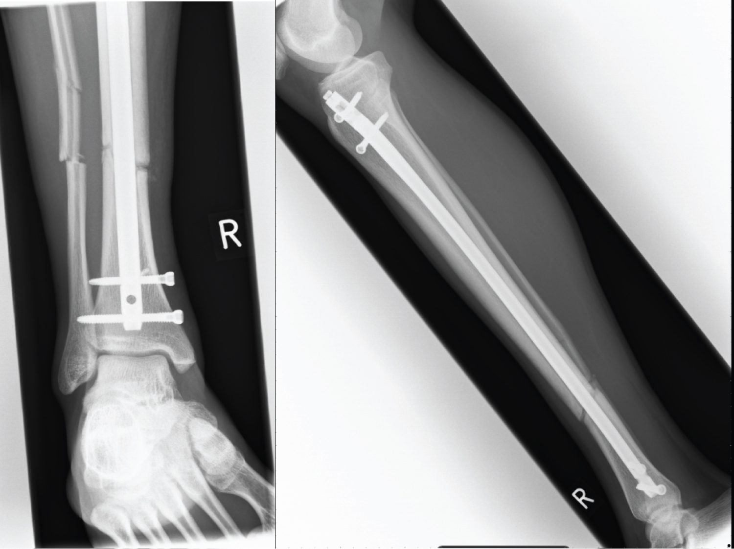 Femoral shaft fracture: Open femoral fracture bone defect treated with the  Precice Bone Transport Nail (Nuvasive) Surgical Technique - OrthOracle