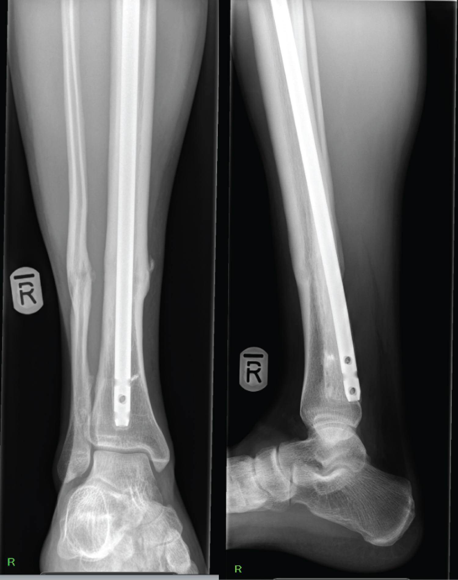 Technique of extracting a compression intramedullary nail that pre- serves  knee arthrodesis