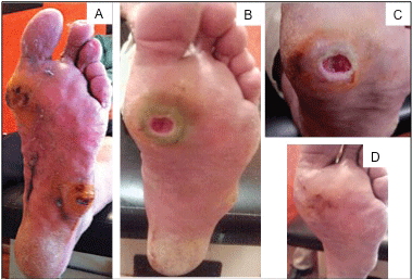 Silver Nanoparticles for the Rapid Healing of Diabetic Foot Ulcers