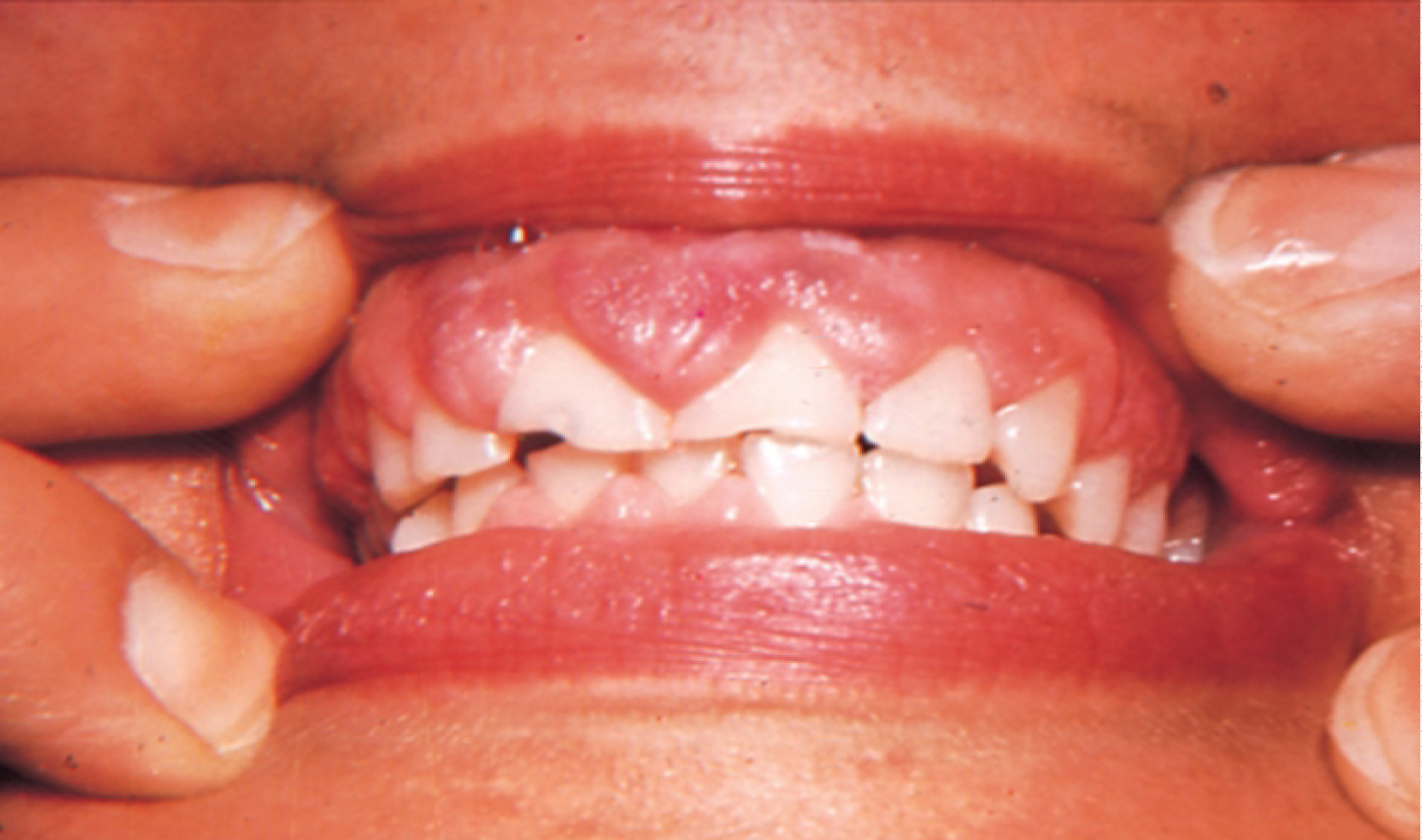 gingival overgrowth