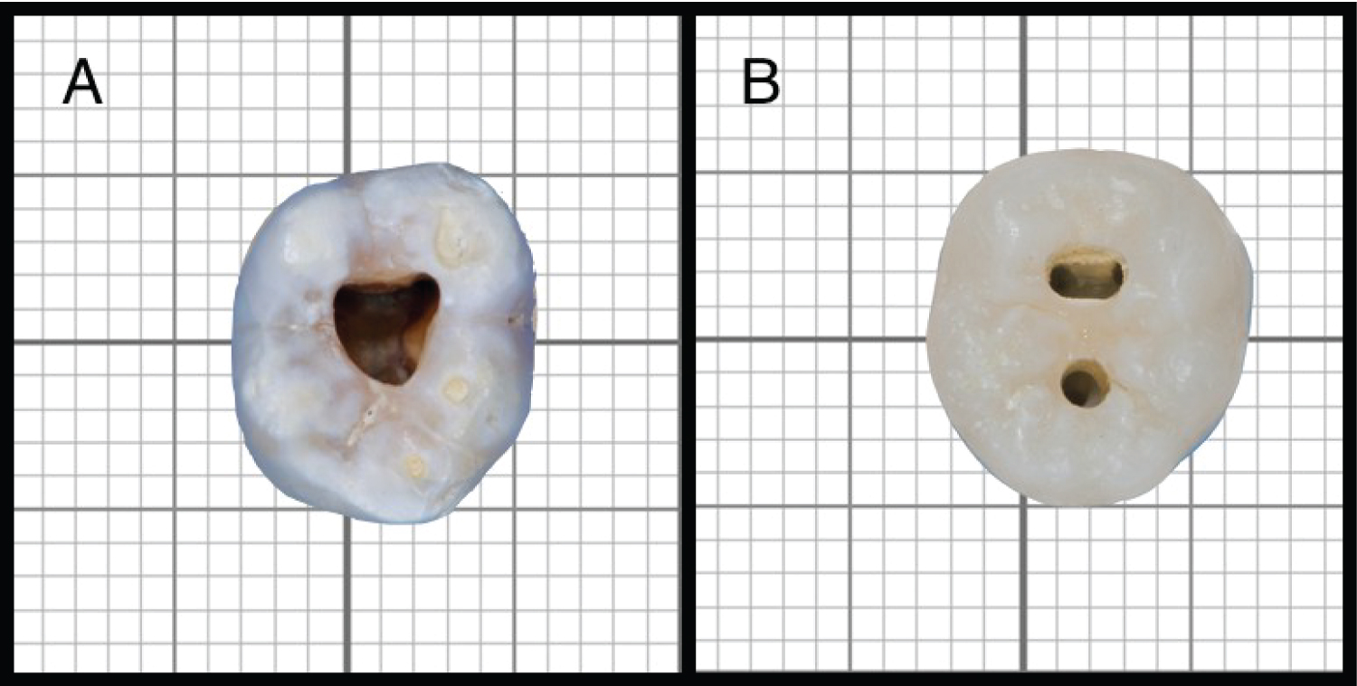Endo Access Molar At Brock Sidney Blog