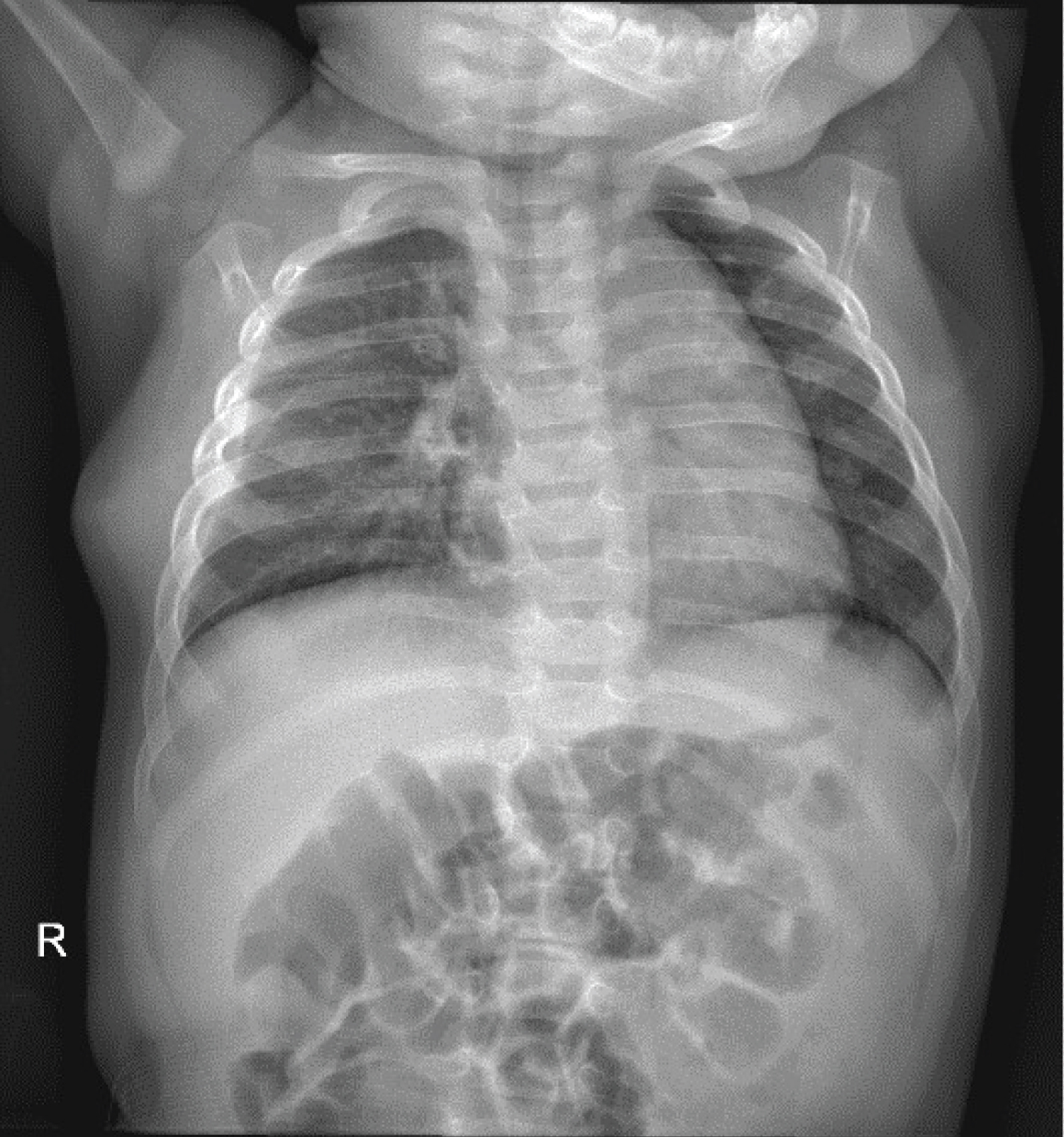 infant pneumothorax x ray