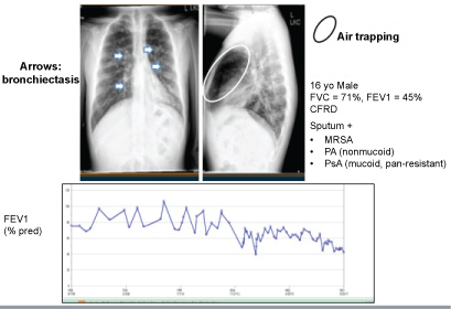 pulmonary rehabilitation for cystic fibrosis