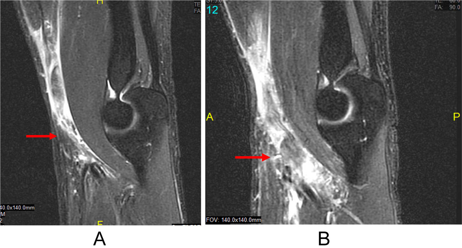 Bilateral Simultaneous Distal Biceps Rupture A Case Report And Review