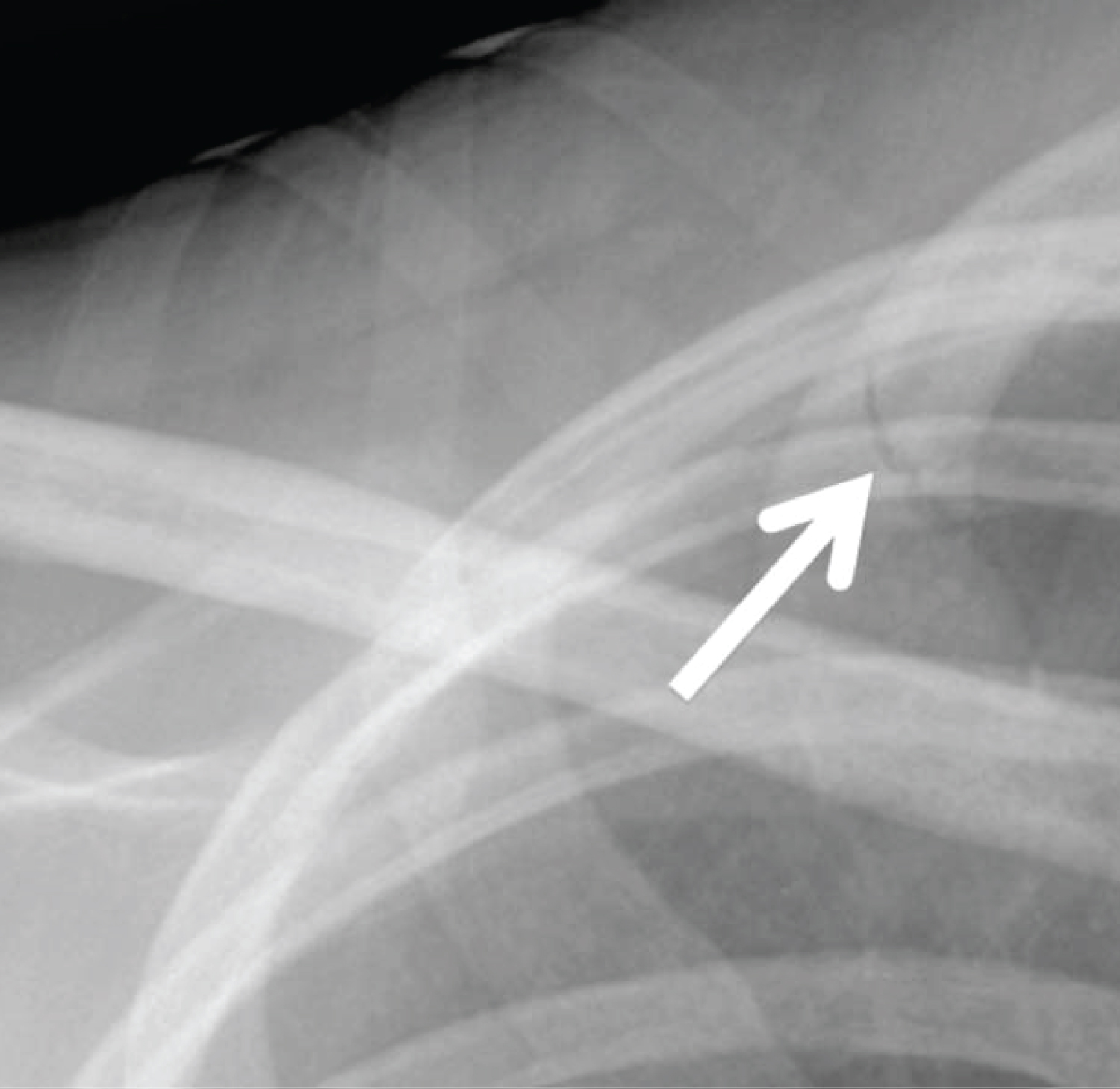 displaced rib fracture