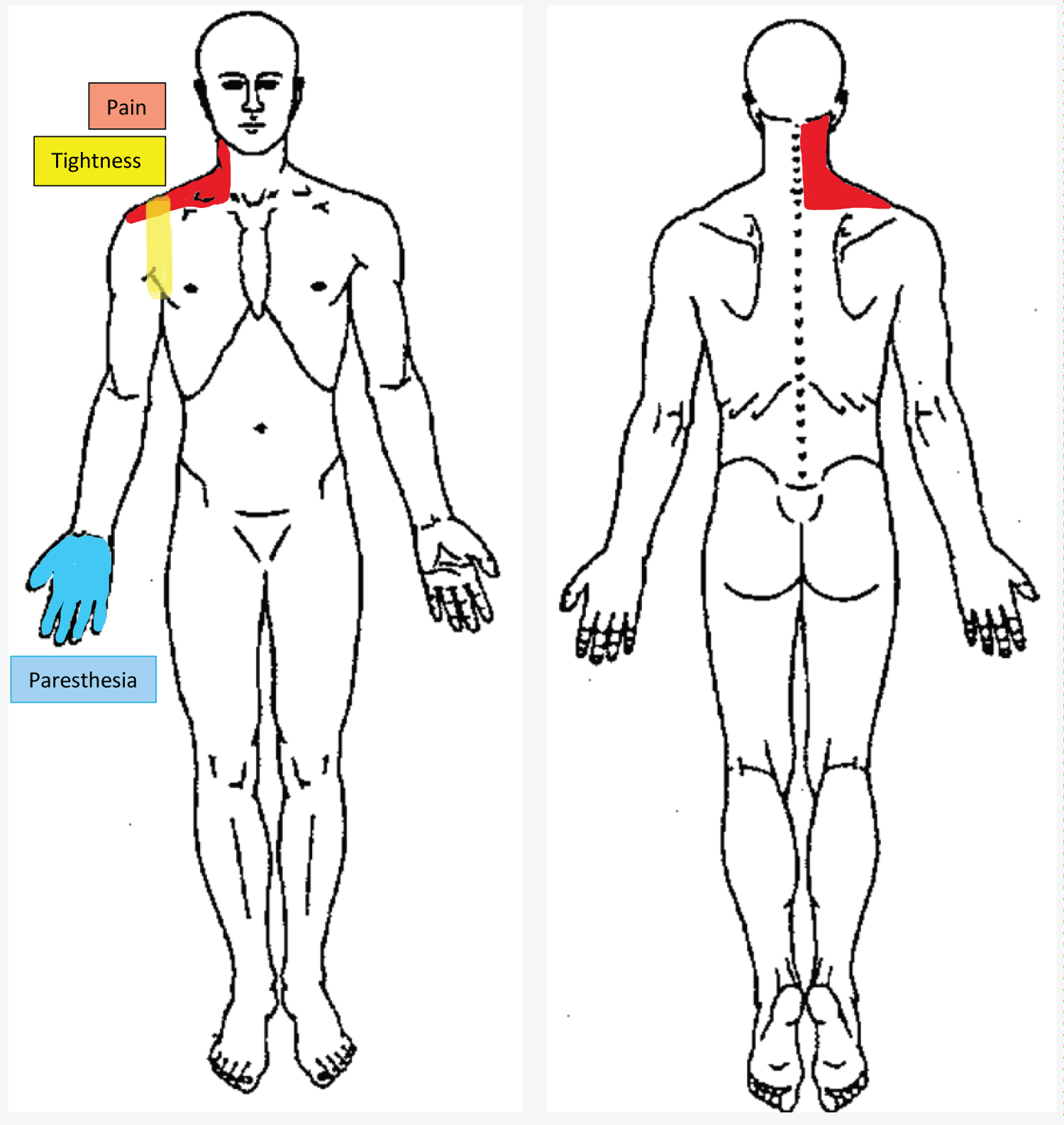 Costoclavicular maneuver  Thoracic Outlet Syndrome Assessment