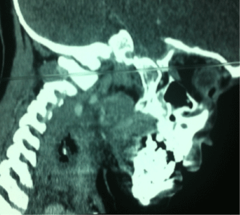Figure 2: CT sagittal image of neck showing the metallic foreign body.