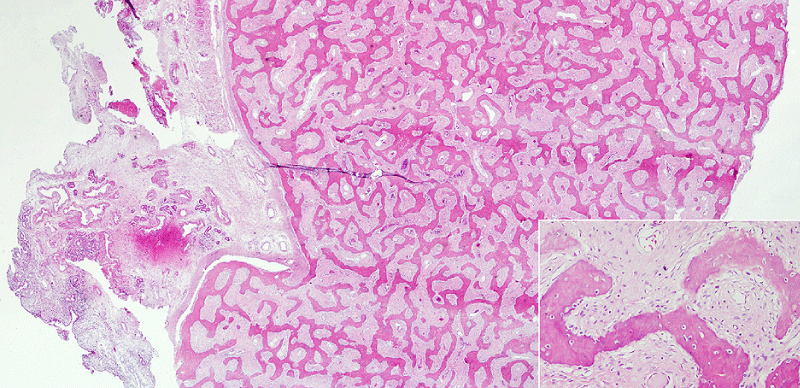 Figure 4: Histopathologic appearance of the lesion; woven bone formation
in a fibrous stroma without osteoblastic cells and immature bony trabeculae
(H&E, x40 ve x200).