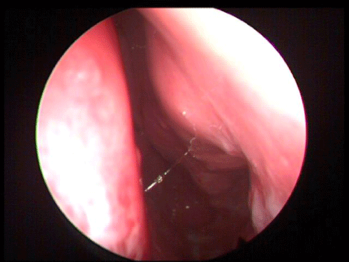 Figure 5: Endoscopic examination after endoscopic resection.