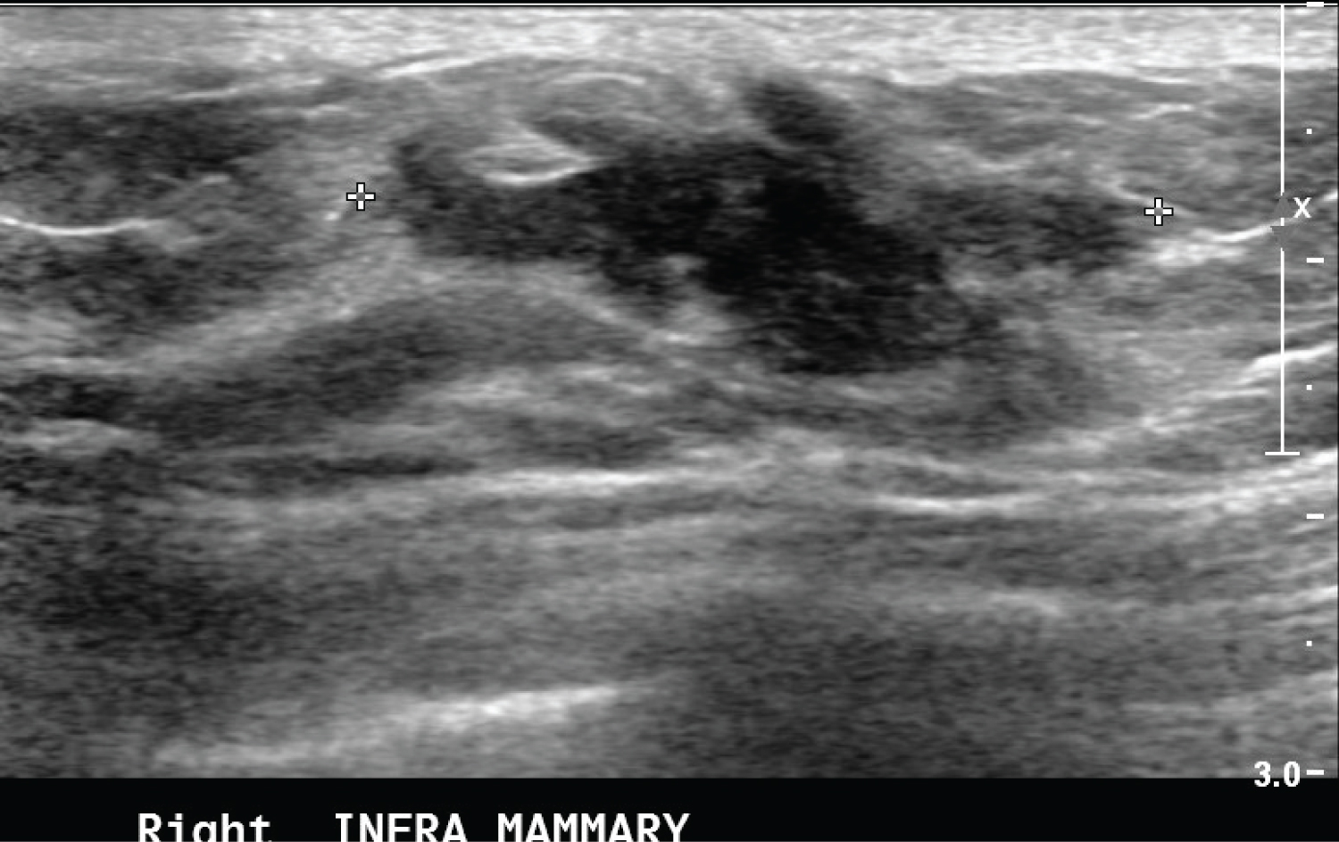 Breast Fibromatosis Case Series And Literature Review