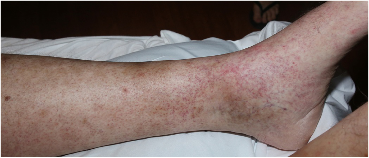 Hepatitis C Rash