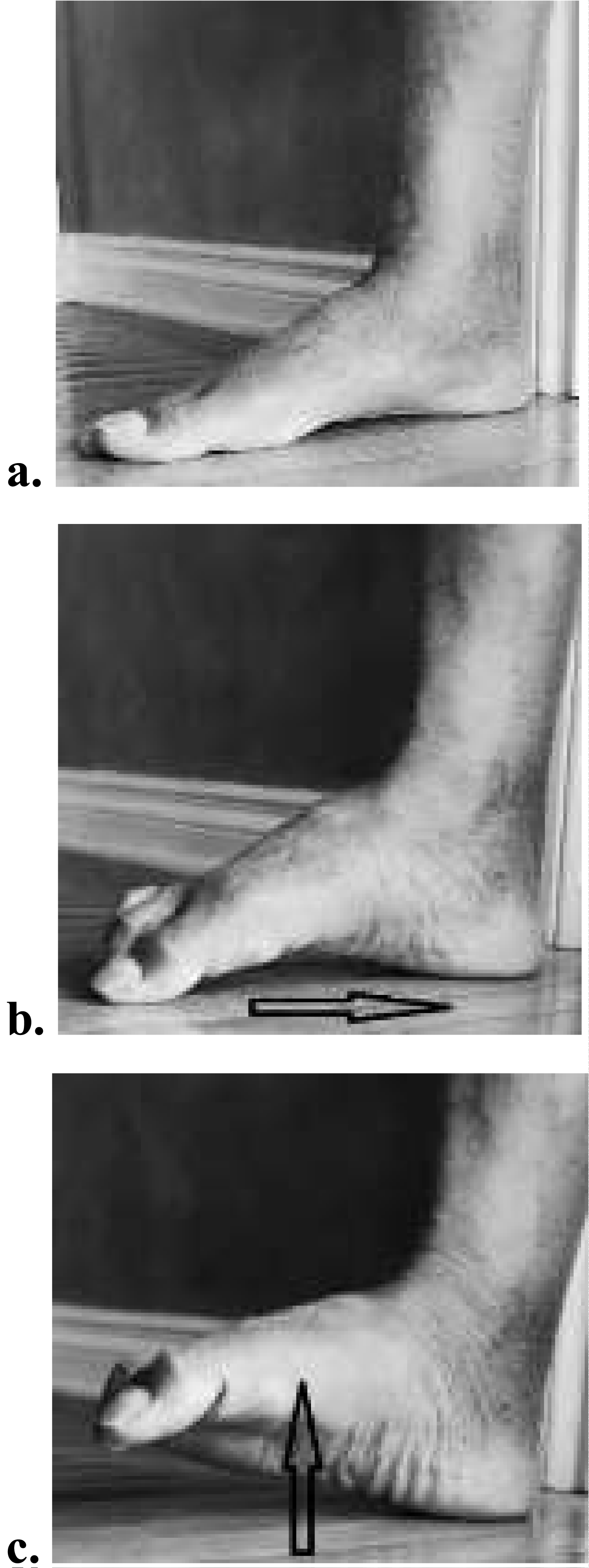 The Active Supination Dorsiflexion Test Guided Therapeutic Intervention for  Shin and Calf Pain: A Case Report