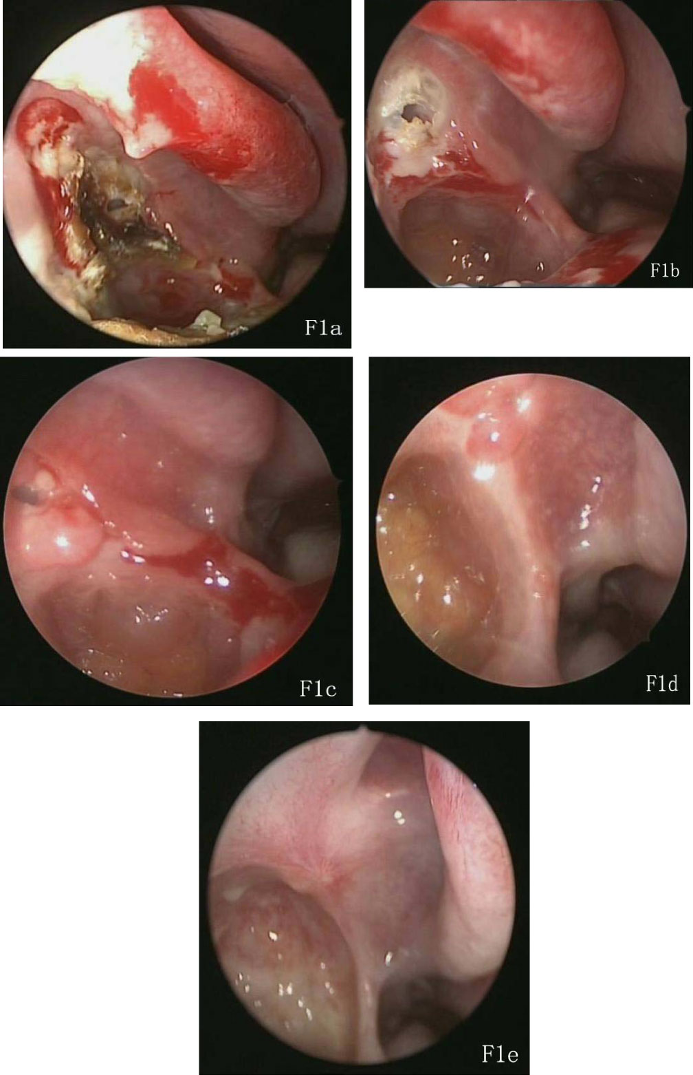 Coblation Assisted Functional Endoscopic Sinus Surgery Improve Prognosis Of The Patients With Chronic Rhinosinusitis And Nasal Polyps